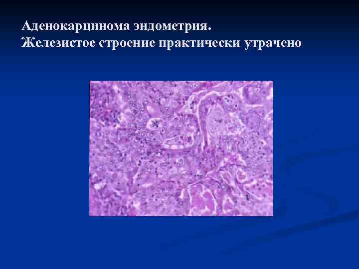 Аденокарцинома эндометрия. Железистое строение практически утрачено 
