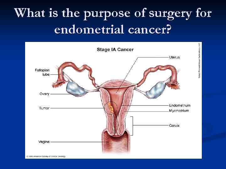 What is the purpose of surgery for endometrial cancer? 
