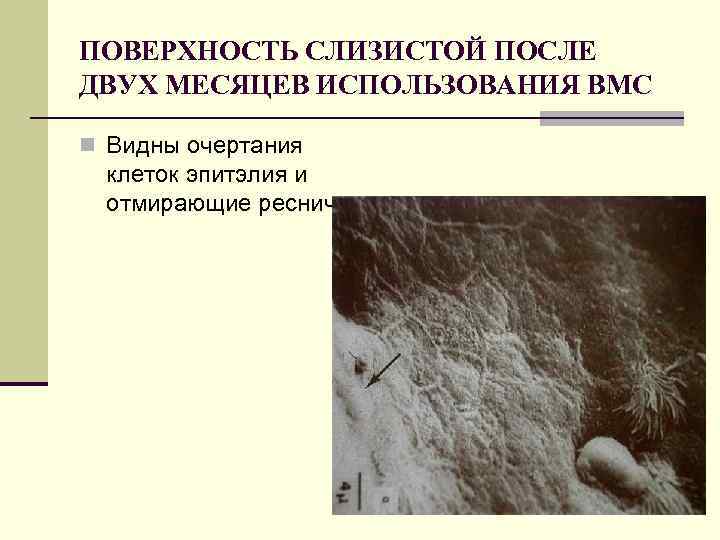 ПОВЕРХНОСТЬ СЛИЗИСТОЙ ПОСЛЕ ДВУХ МЕСЯЦЕВ ИСПОЛЬЗОВАНИЯ ВМС n Видны очертания клеток эпитэлия и отмирающие