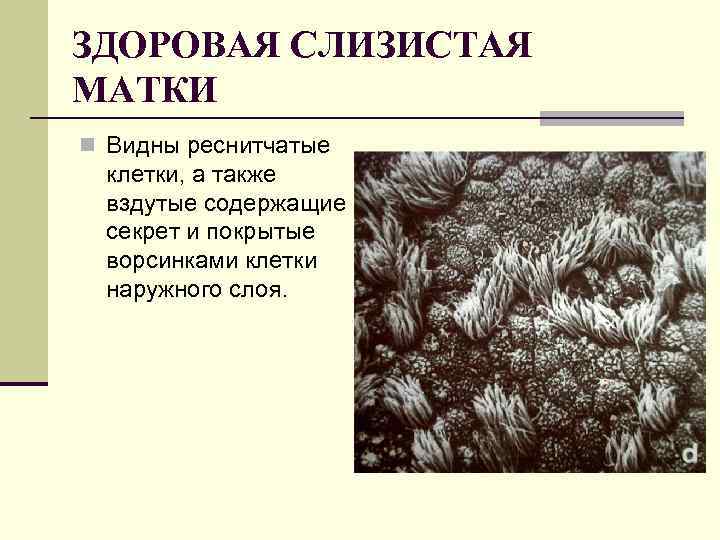 ЗДОРОВАЯ СЛИЗИСТАЯ МАТКИ n Видны реснитчатые клетки, а также вздутые содержащие секрет и покрытые