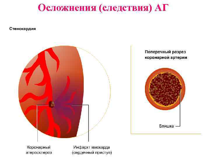 Осложнения (следствия) АГ 