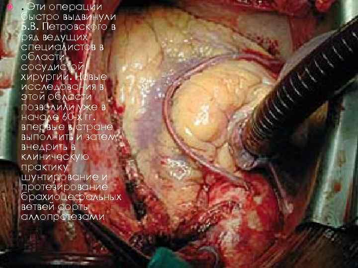  . Эти операции быстро выдвинули Б. В. Петровского в ряд ведущих специалистов в