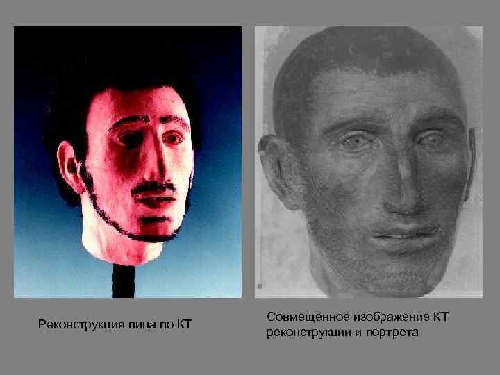 Реконструкция лица по КТ Совмещенное изображение КТ реконструкции и портрета 