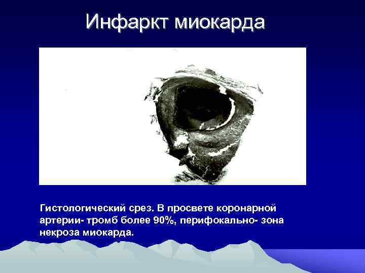 Инфаркт миокарда Гистологический срез. В просвете коронарной артерии- тромб более 90%, перифокально- зона некроза