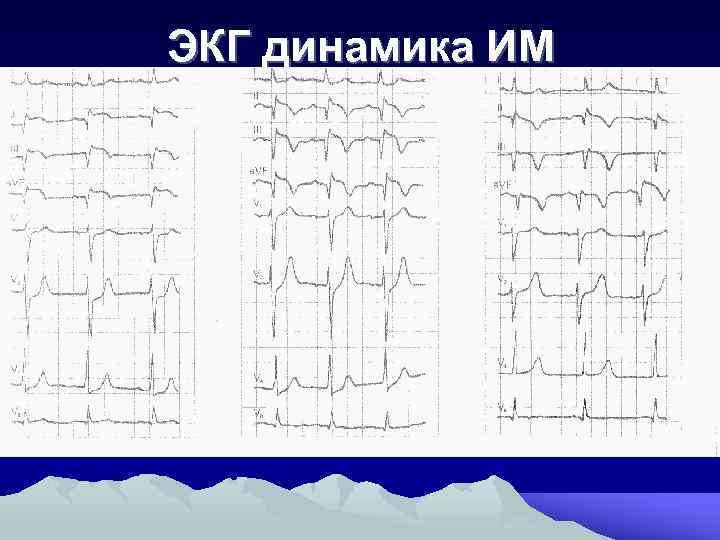 ЭКГ динамика ИМ 