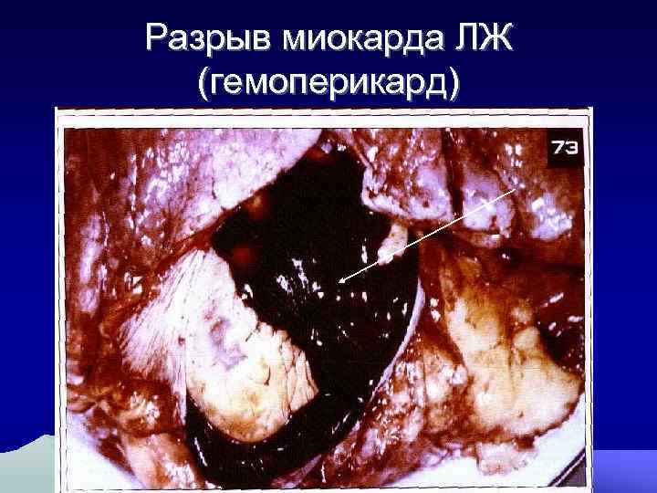 Разрыв миокарда ЛЖ (гемоперикард) 