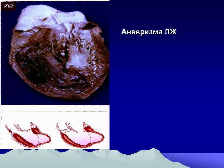 Аневризма ЛЖ 