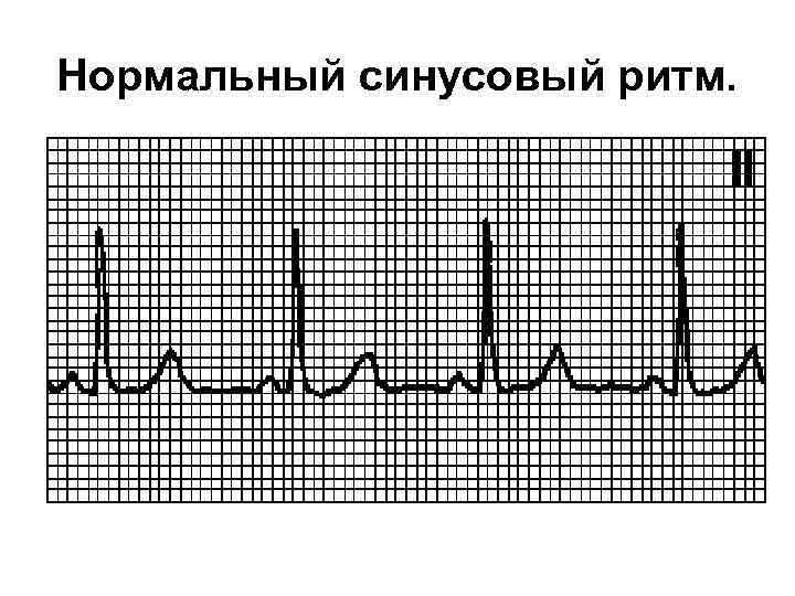 Нормальный синусовый ритм. 