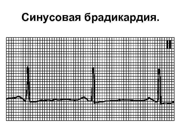 Синусовая брадикардия. 