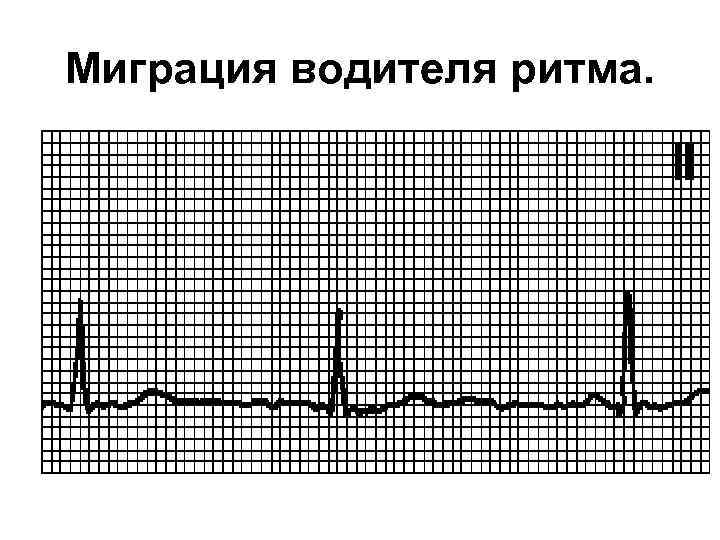Миграция водителя ритма. 