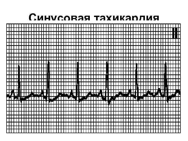 Синусовая тахикардия 