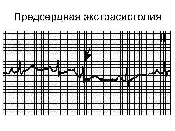 Предсердная экстрасистолия 