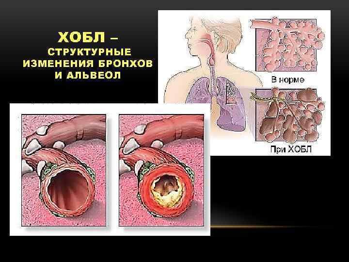 ХОБЛ – СТРУКТУРНЫЕ ИЗМЕНЕНИЯ БРОНХОВ И АЛЬВЕОЛ 