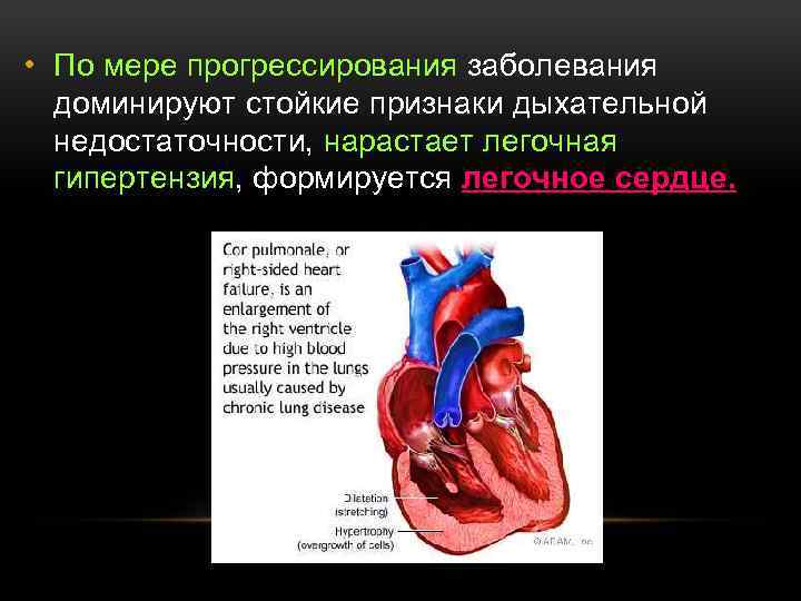  • По мере прогрессирования заболевания доминируют стойкие признаки дыхательной недостаточности, нарастает легочная гипертензия,