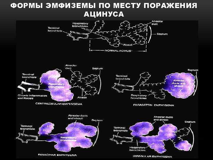 ФОРМЫ ЭМФИЗЕМЫ ПО МЕСТУ ПОРАЖЕНИЯ АЦИНУСА 