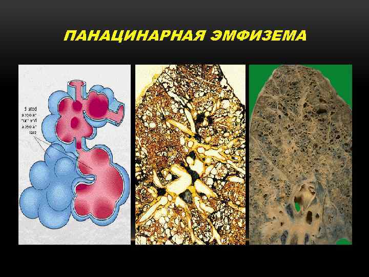 ПАНАЦИНАРНАЯ ЭМФИЗЕМА 