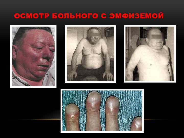 ОСМОТР БОЛЬНОГО С ЭМФИЗЕМОЙ 