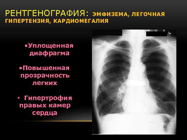 РЕНТГЕНОГРАФИЯ: ЭМФИЗЕМА, ЛЕГОЧНАЯ ГИПЕРТЕНЗИЯ, КАРДИОМЕГАЛИЯ • Уплощенная диафрагма • Повышенная прозрачность легких • Гипертрофия