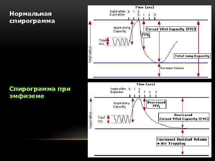 Нормальная спирограмма Спирограмма при эмфиземе 