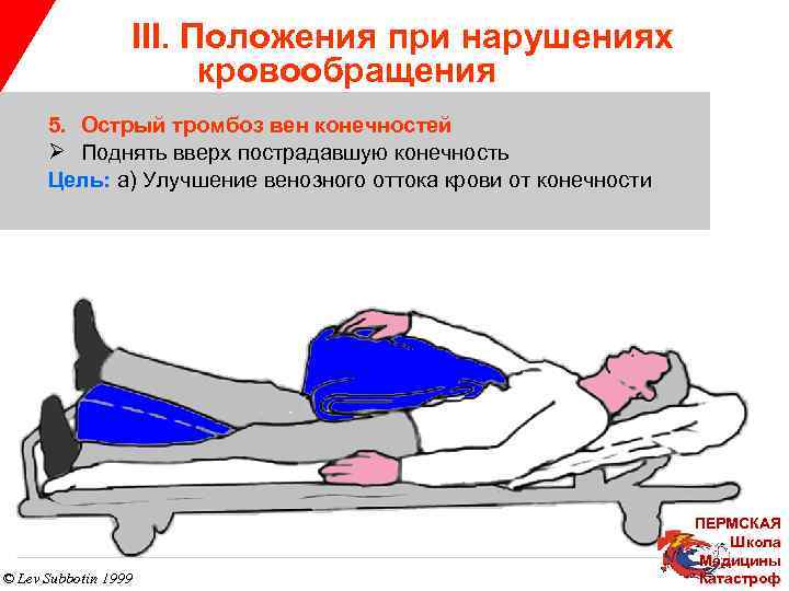 III. Положения при нарушениях кровообращения 5. Острый тромбоз вен конечностей Ø Поднять вверх пострадавшую