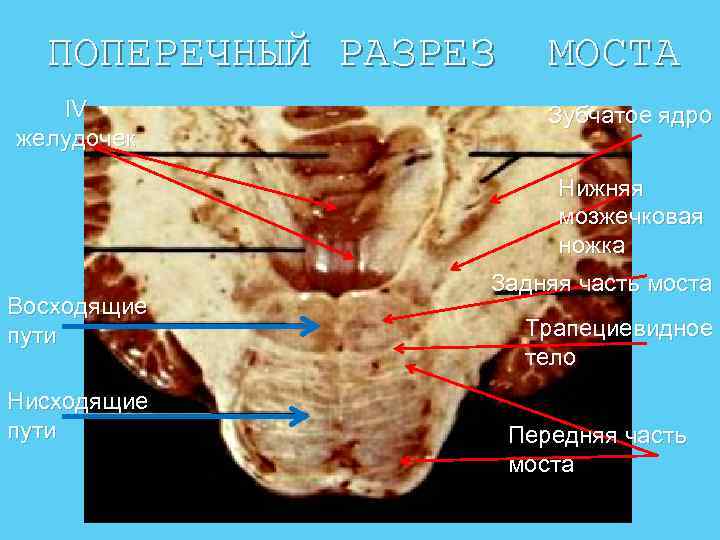 Мостомозжечковый угол фото