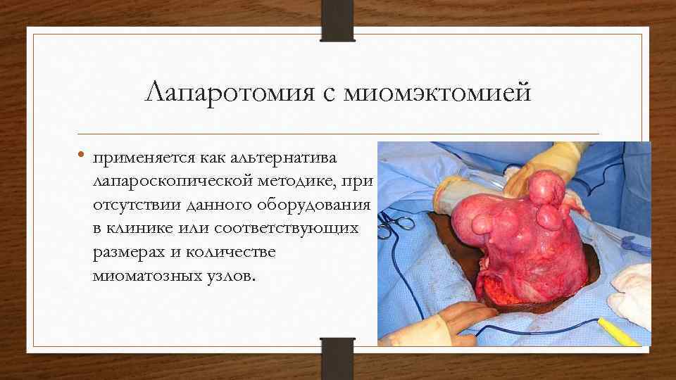 Лапаротомия с миомэктомией • применяется как альтернатива лапароскопической методике, при отсутствии данного оборудования в