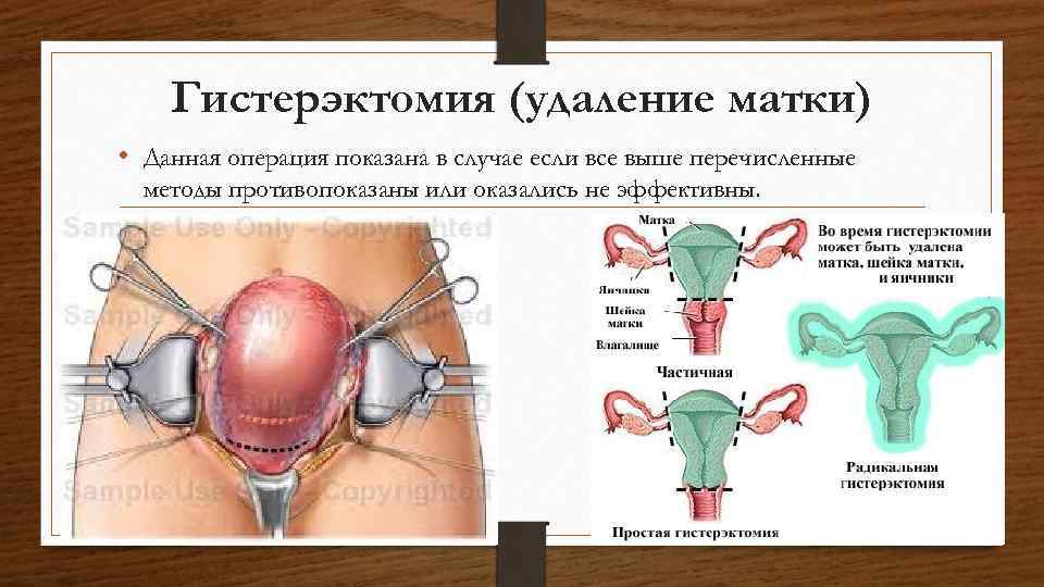 Гистерэктомия (удаление матки) • Данная операция показана в случае если все выше перечисленные методы