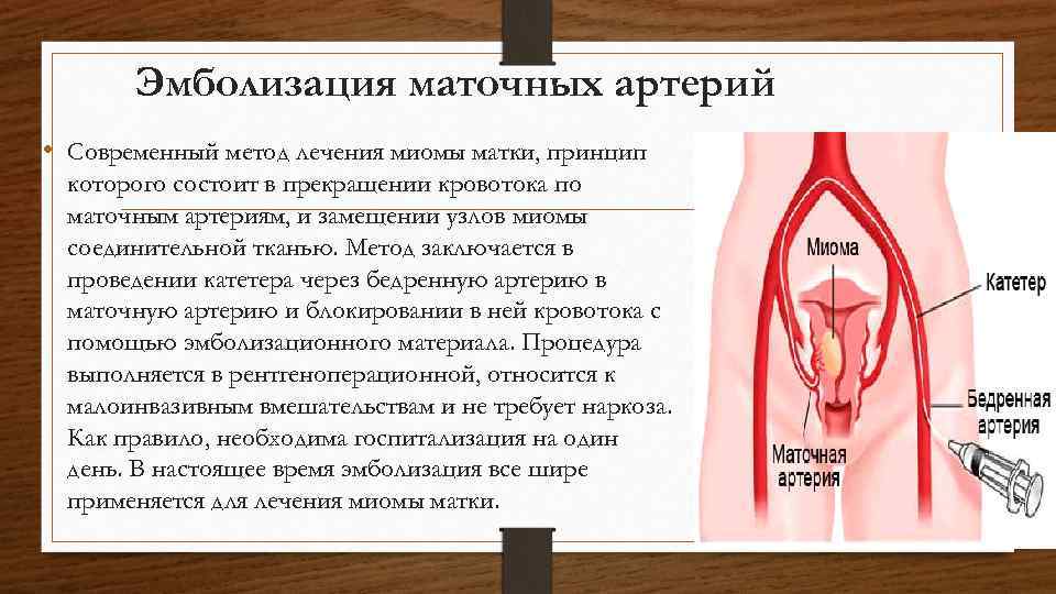 Эмболизация маточных артерий • Современный метод лечения миомы матки, принцип которого состоит в прекращении