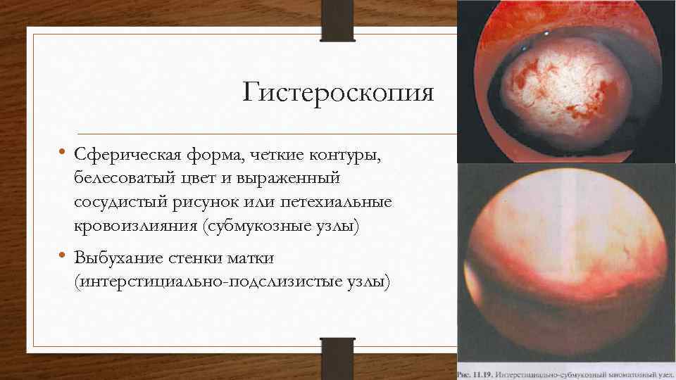 Гистероскопия • Сферическая форма, четкие контуры, белесоватый цвет и выраженный сосудистый рисунок или петехиальные
