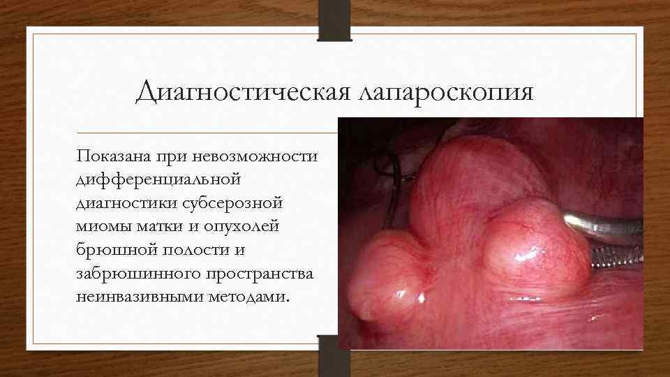 Диагностическая лапароскопия Показана при невозможности дифференциальной диагностики субсерозной миомы матки и опухолей брюшной полости