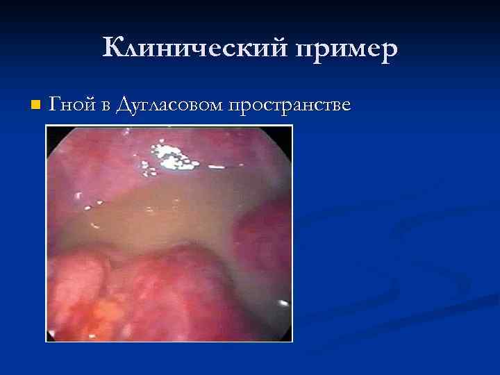Клинический пример n Гной в Дугласовом пространстве 
