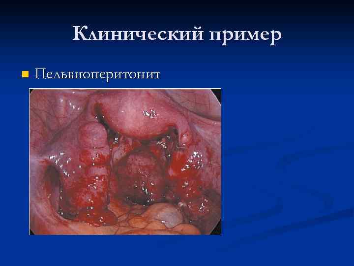 Клинический пример n Пельвиоперитонит 