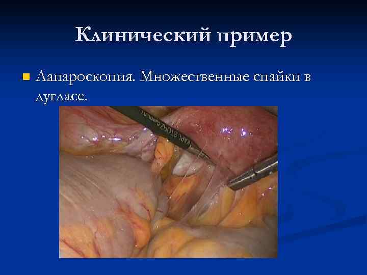 Клинический пример n Лапароскопия. Множественные спайки в дугласе. 