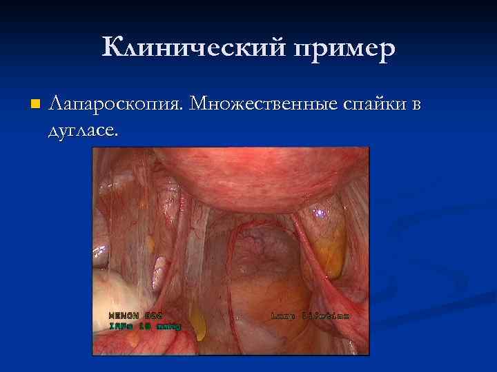 Клинический пример n Лапароскопия. Множественные спайки в дугласе. 