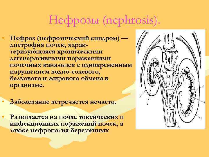 Нефрозы (nephrosis). • Нефроз (нефротический синдром) — дистрофия почек, характеризующаяся хроническими дегенеративными поражениями почечных