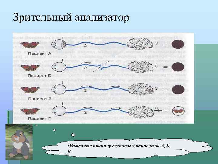 Зрительный анализатор Объясните причину слепоты у пациентов А, Б, В 