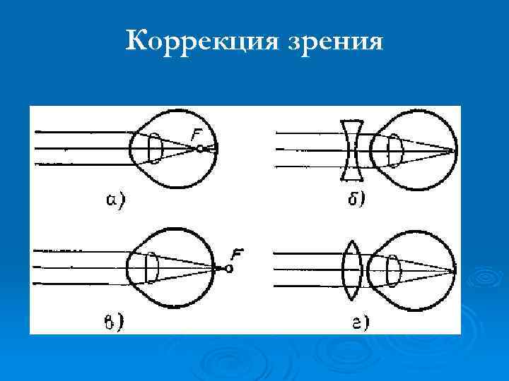 Коррекция зрения 