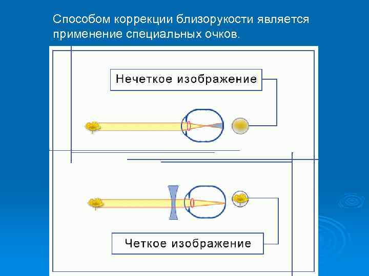 Способом коррекции близорукости является применение специальных очков. 