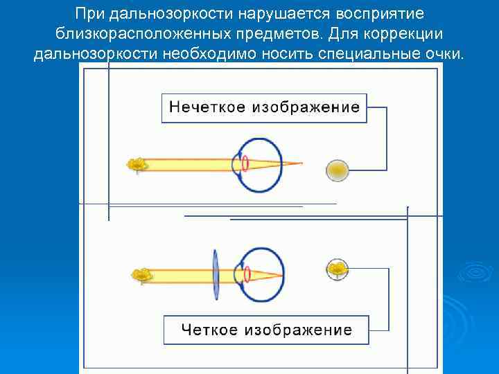 Расплывчатое изображение далеко расположенных предметов является признаком