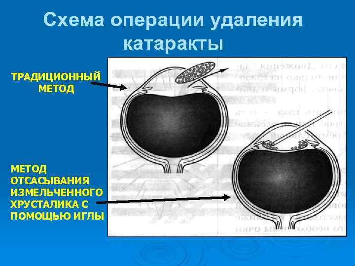 Схема операции удаления катаракты ТРАДИЦИОННЫЙ МЕТОД ОТСАСЫВАНИЯ ИЗМЕЛЬЧЕННОГО ХРУСТАЛИКА С ПОМОЩЬЮ ИГЛЫ 