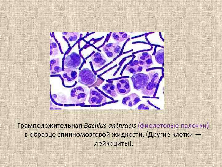 Грамположительная Bacillus anthracis (фиолетовые палочки) в образце спинномозговой жидкости. (Другие клетки — лейкоциты). 