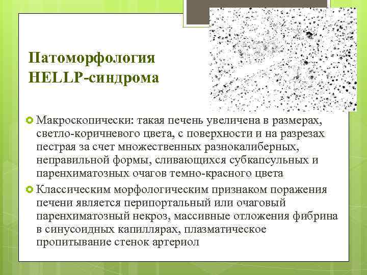 Патоморфология HELLP-синдрома Макроскопически: такая печень увеличена в размерах, светло-коричневого цвета, с поверхности и на