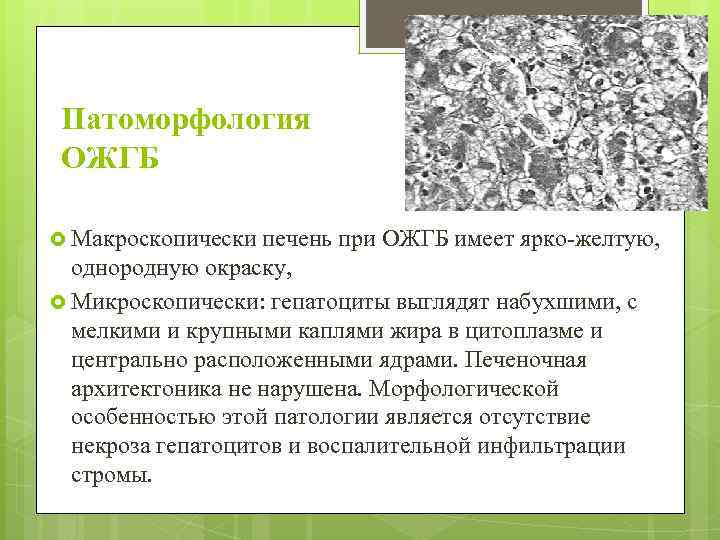 Патоморфология ОЖГБ Макроскопически печень при ОЖГБ имеет ярко-желтую, однородную окраску, Микроскопически: гепатоциты выглядят набухшими,