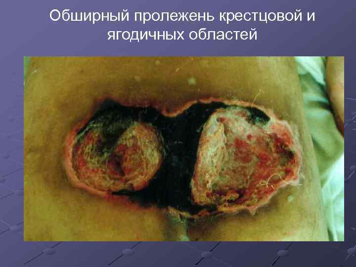 Обширный пролежень крестцовой и ягодичных областей 