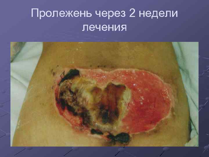 Пролежень через 2 недели лечения 