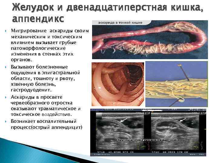 Желудок и двенадцатиперстная кишка, аппендикс Мигрирование аскариды своим механическим и токсическим влиянием вызывает грубые