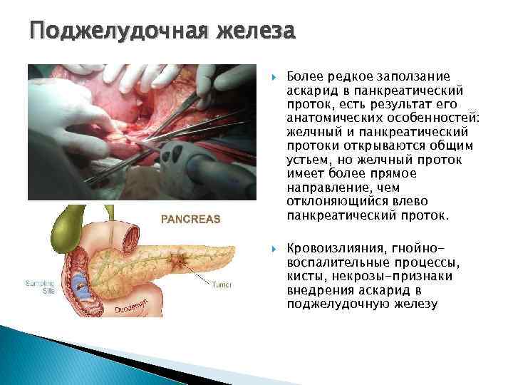 Поджелудочная железа Более редкое заползание аскарид в панкреатический проток, есть результат его анатомических особенностей: