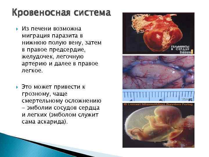 Кровеносная система Из печени возможна миграция паразита в нижнюю полую вену, затем в правое