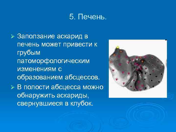 5. Печень. Заползание аскарид в печень может привести к грубым патоморфологическим изменениям с образованием