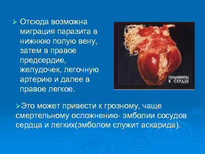 Ø Отсюда возможна миграция паразита в нижнюю полую вену, затем в правое предсердие, желудочек,